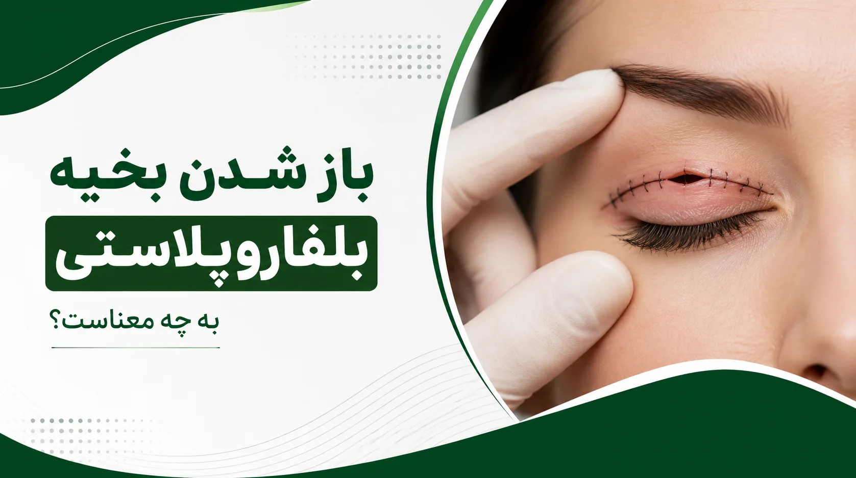 باز شدن بخیه بلفاروپلاستی به چه معناست؟